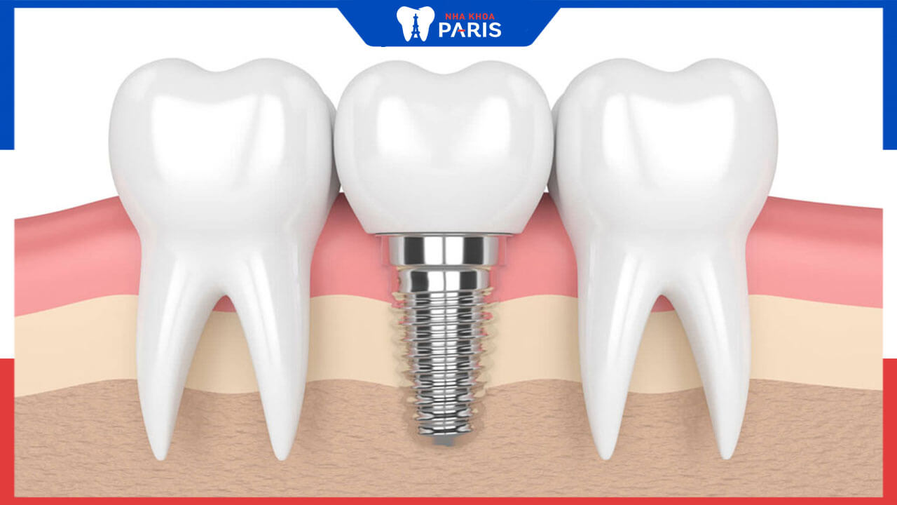 Tuổi thọ của răng Implant là bao lâu? Bác sĩ nha khoa paris trả lời